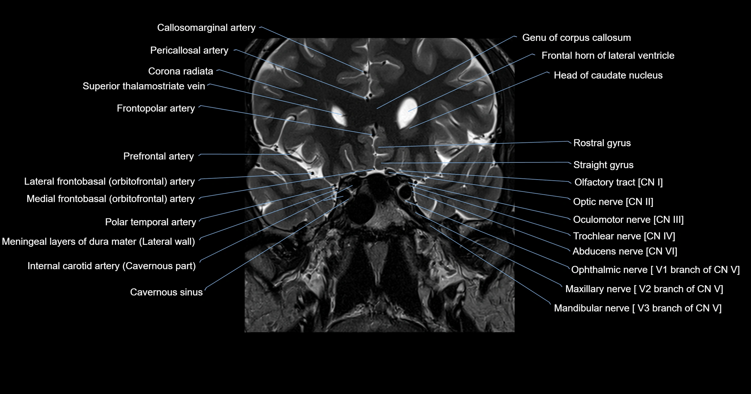 MRI brainstem & basal ganglia anatomy labelled 3T MRI images -img-00001-00007.webp